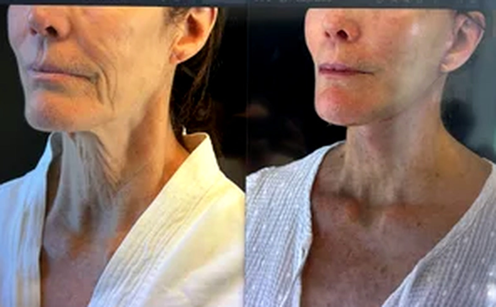 Before and after — real patient of Dr. Shim Ching